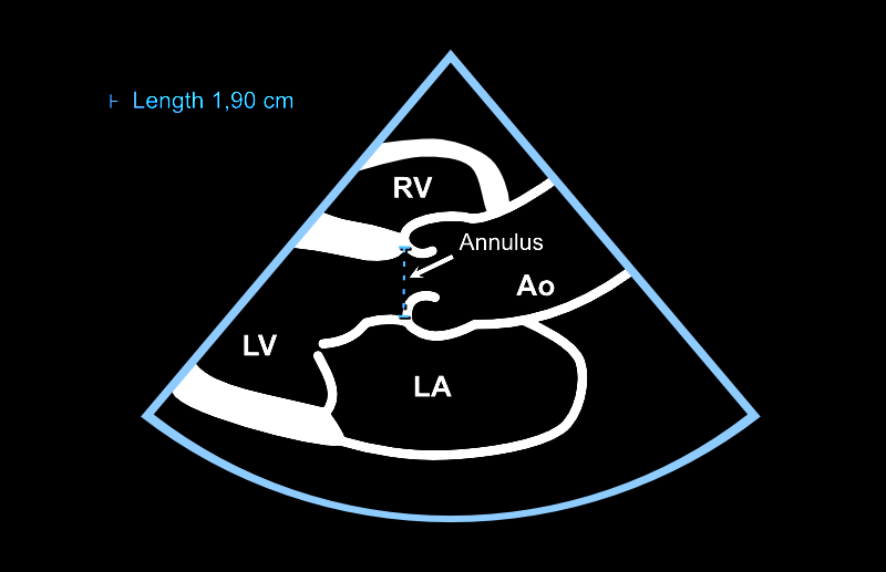 Aortan annulus mitataan keskisystolessa.