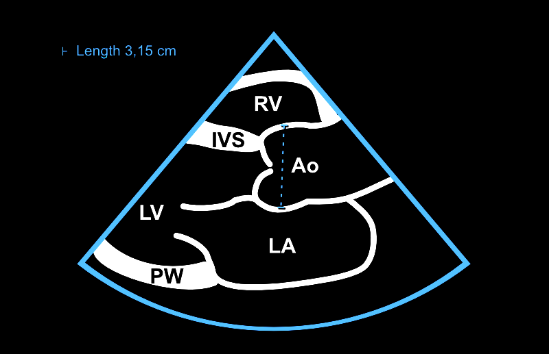 Aortan tyven mittaus 2D-kuvasta. Mittaus suoritetaan kun aorttaläppä on kiinni (loppudiastolessa).