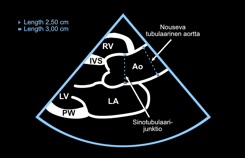 Sinotubulaarijunktio ja nouseva tubulaarinen aortta. Mittaus suoritetaan loppudiastolessa.