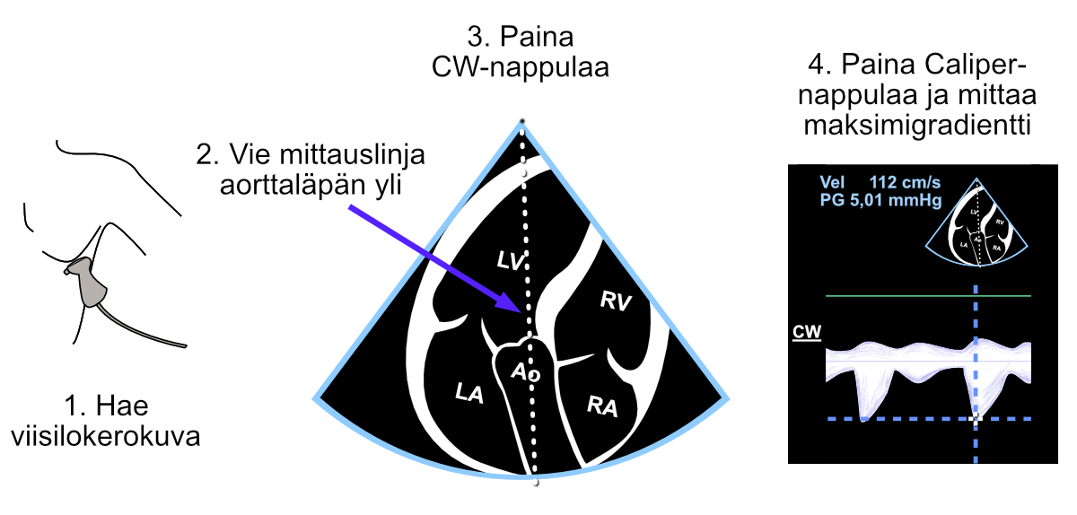 Gradientin mittaus “nimettömästi” Caliper-painikkeella aorttaläpän yli jatkuvan dopplerin signaalista.