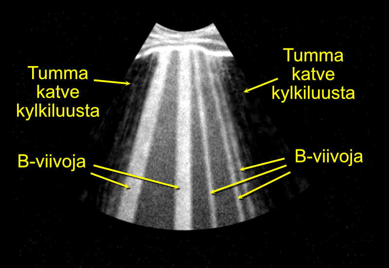 Keuhkokongestion arviointi B-viivoja etsimällä.