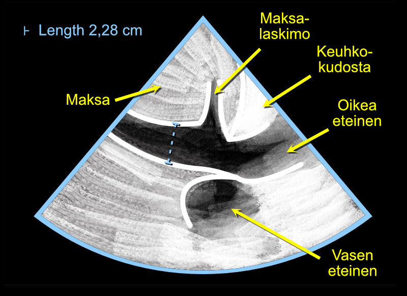 Alaonttolaskimon (IVC:n) läpimitan mittaaminen Caliper-nappulalla. Huom. Mittaa läpimitta sekä ekspiriumissa että inspiriumissa.