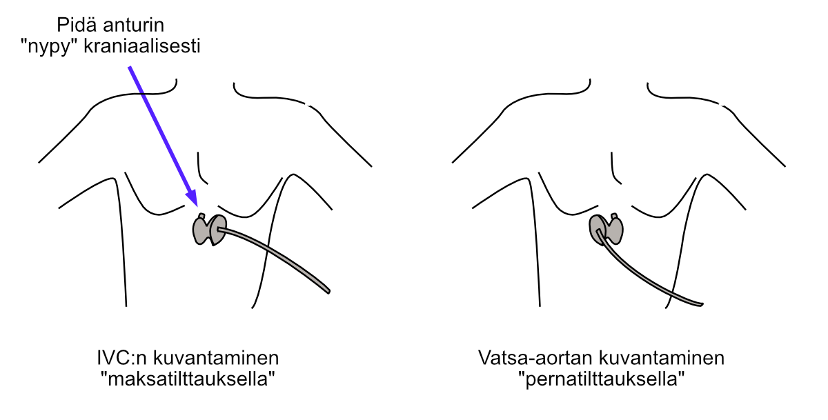 Alaonttolaskimon ja vatsa-aortan identifiointi “maksa- ja pernatilttauksella”.