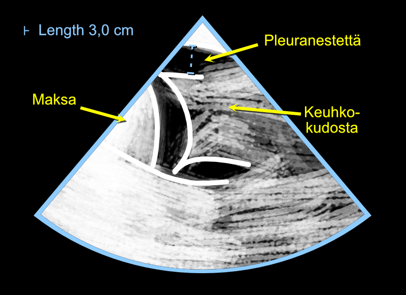 Pleuranesteen määrän arvioiminen sydämen kaikukuvauslaitteella.