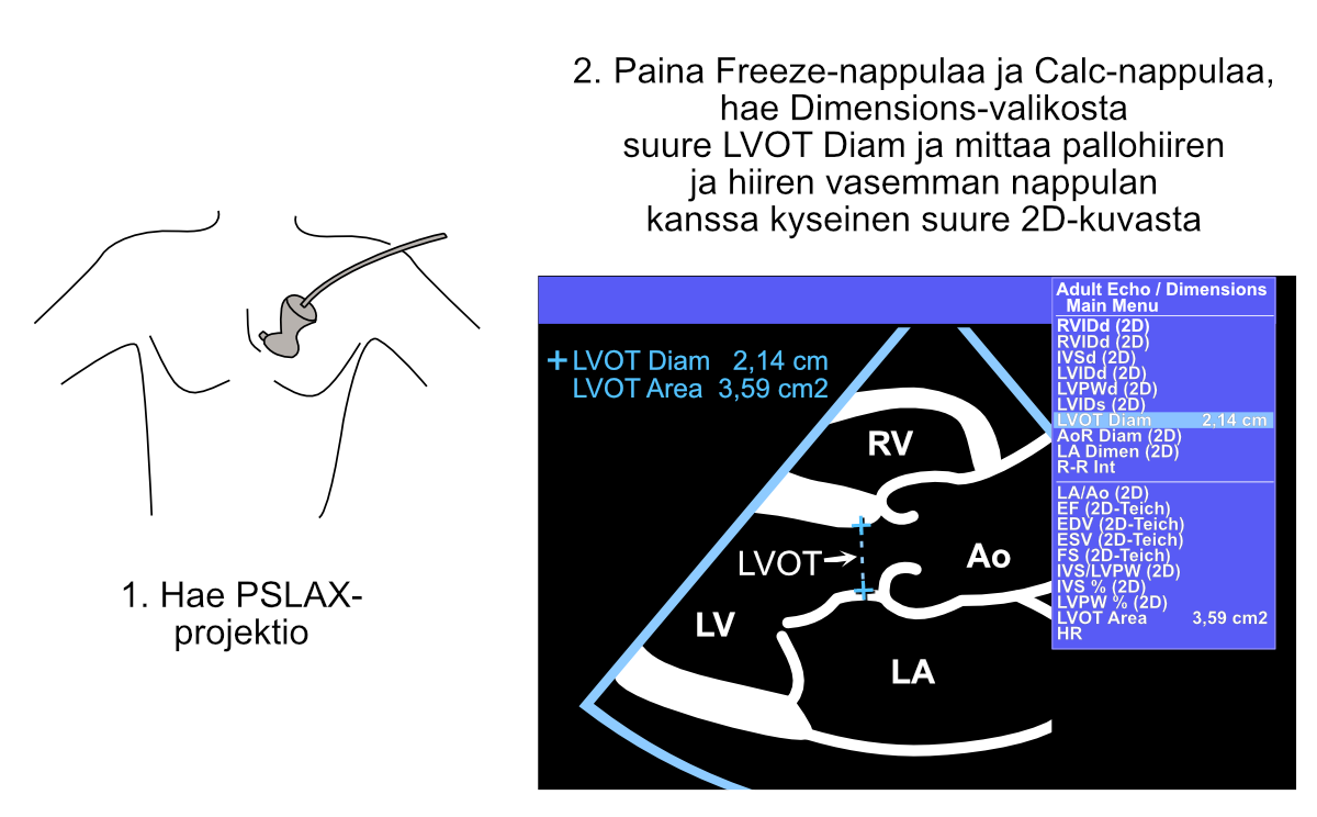 Vasemman ulosvirtauskanavan (LVOT:n) läpimitan mittaus.