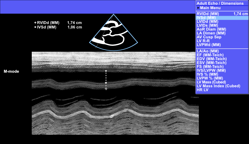 Kammioseptumin (IVS) mittaus M-moodilla.