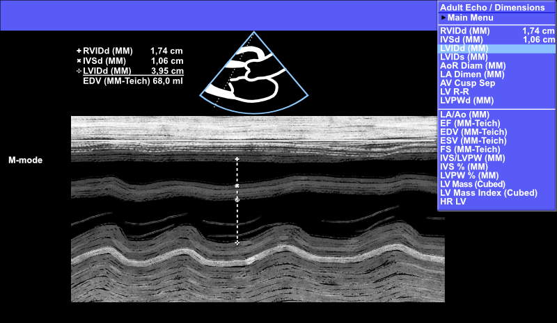 Vasemman kammion diastolisen läpimitan (LVIDd) mittaus M-moodilla.