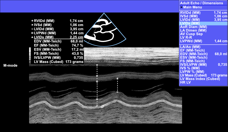 Vasemman kammion systolisen läpimitan (LVIDs) mittaus M-moodilla.