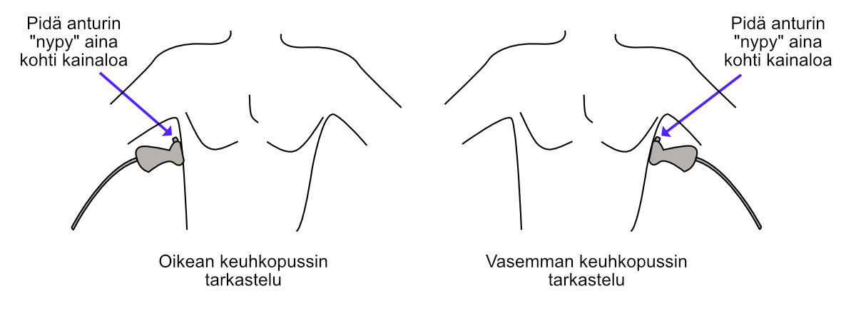 Alaonttolaskimon (IVC:n) mittaaminen Caliper-nappulalla.