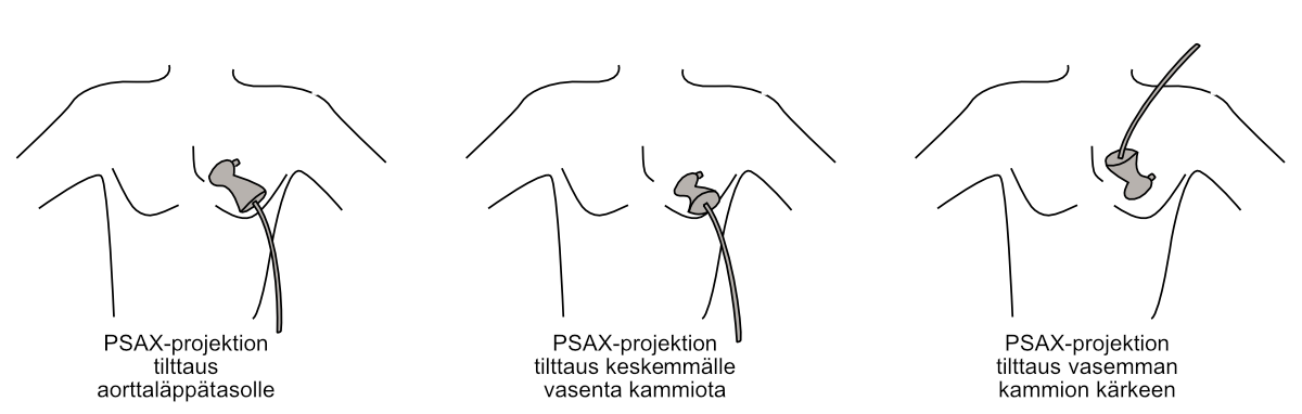 Parasternaalisen lyhyen akselin projektion tilttaaminen eri leiketasoille.