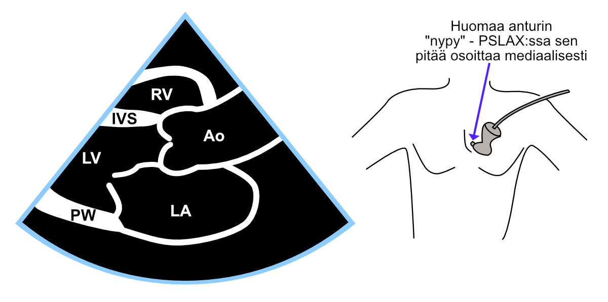 Parasternaalinen pitkittäisprojektio (PSLAX).