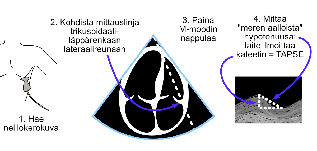 TAPSEn mittaus M-moodilla.