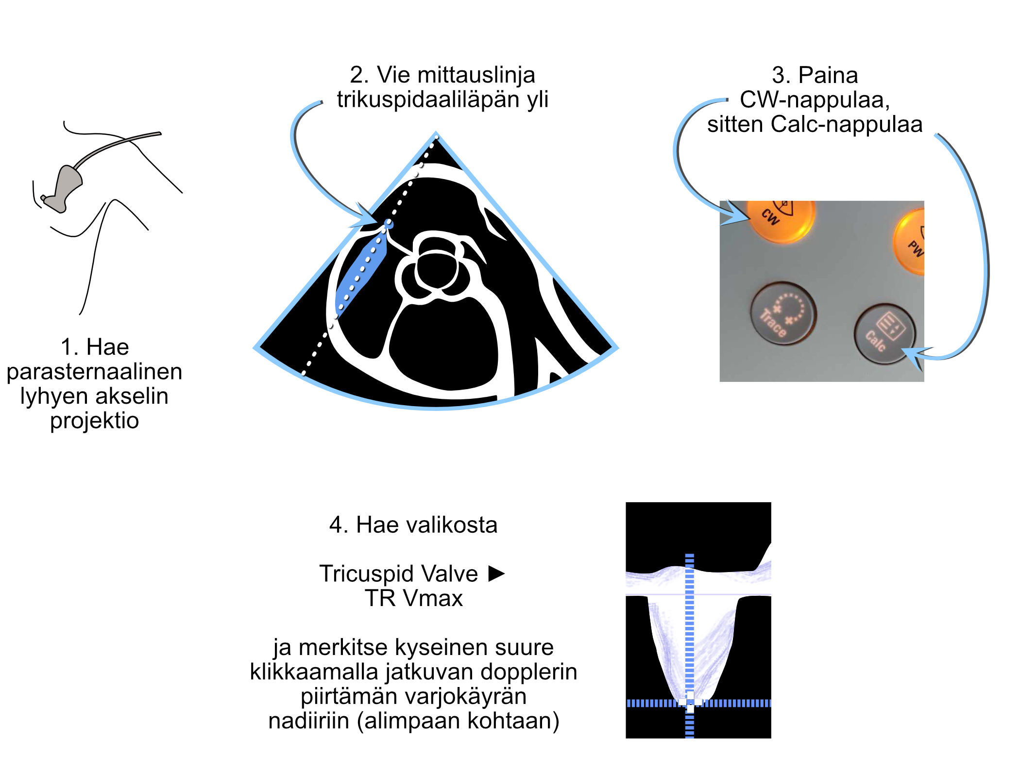 RV/RA-gradientin mittaaminen jatkuvalla dopplerilla trikuspidaalivuodosta.