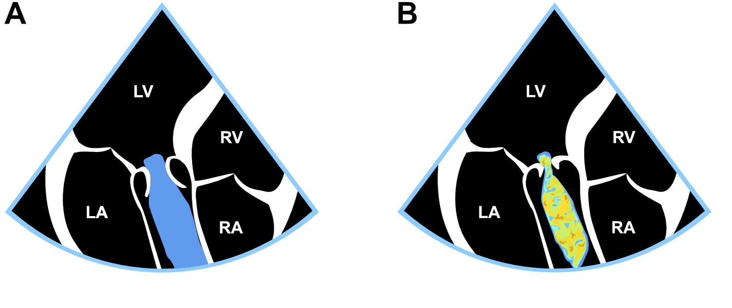 Laminaarinen (A) ja turbulentti (B) virtaus.